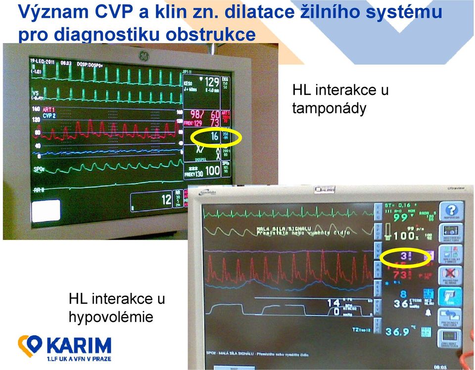 diagnostiku obstrukce HL