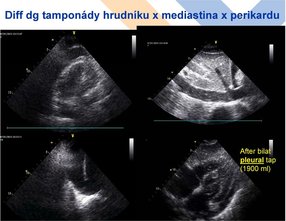 x perikardu After