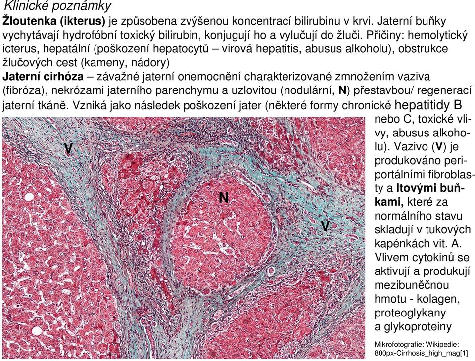 zmnožením vaziva (fibróza), nekrózami jaterního parenchymu a uzlovitou (nodulární, N) přestavbou/ regenerací jaterní tkáně.