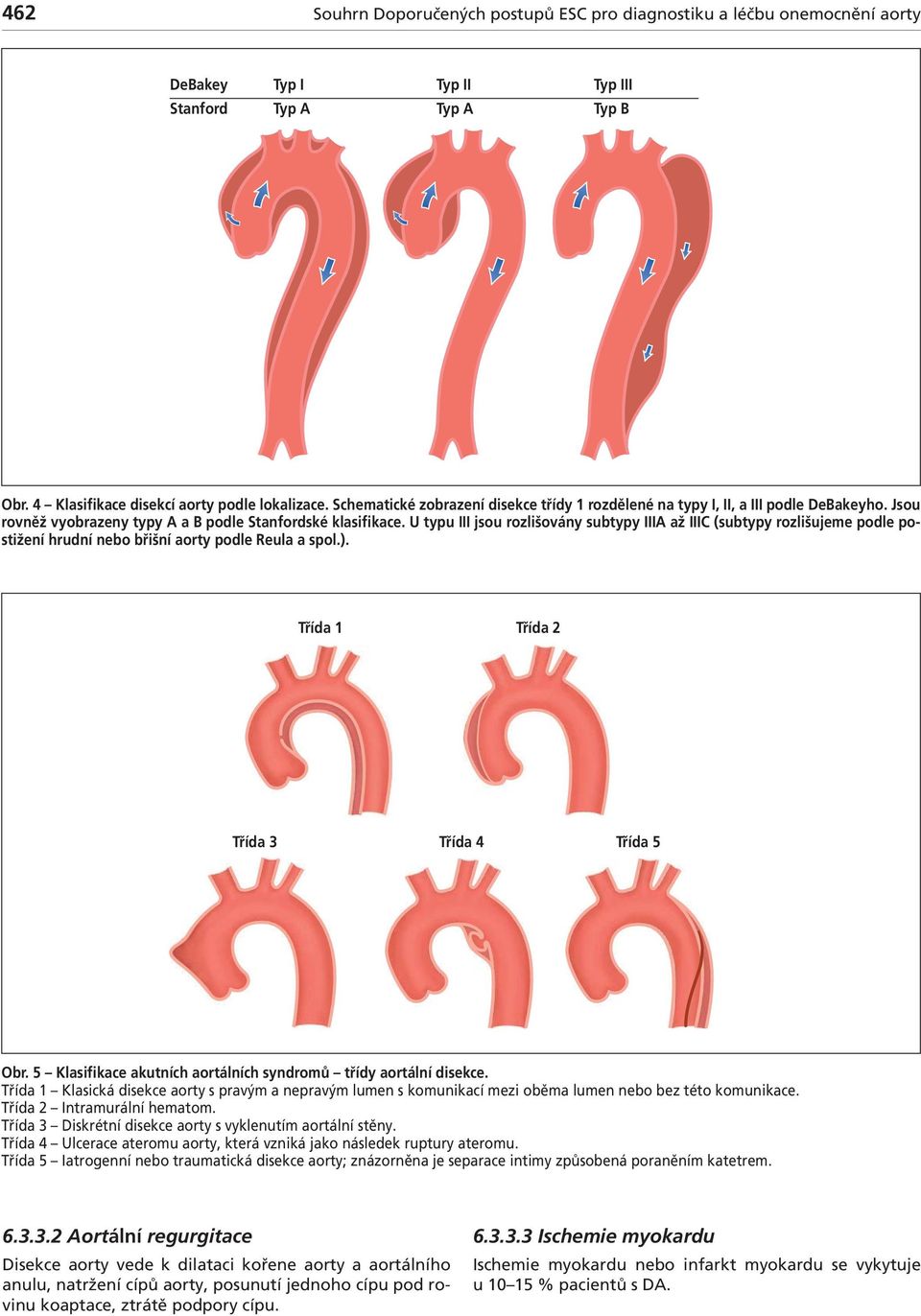 U typu jsou rozlišovány sutypy A ž (sutypy rozlišujeme podle postižení hrudní neo řišní orty podle Reul spol.). Tříd 1 Tříd 2 Tříd 3 Tříd 4 Tříd 5 Or.