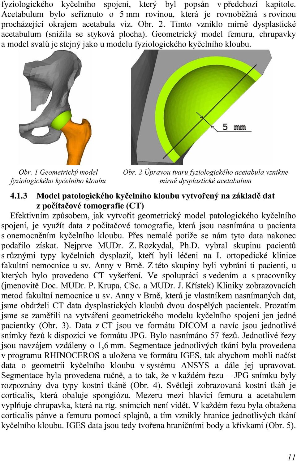 1 Geometrický model fyziologického kyčelního kloubu Obr. 2 Úpravou tvaru fyziologického acetabula vznikne mírně dysplastické acetabulum 4.1.3 Model patologického kyčelního kloubu vytvořený na základě