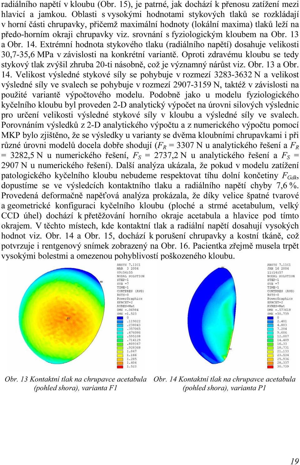 srovnání s fyziologickým kloubem na Obr. 13 a Obr. 14. Extrémní hodnota stykového tlaku (radiálního napětí) dosahuje velikosti 30,7-35,6 MPa v závislosti na konkrétní variantě.