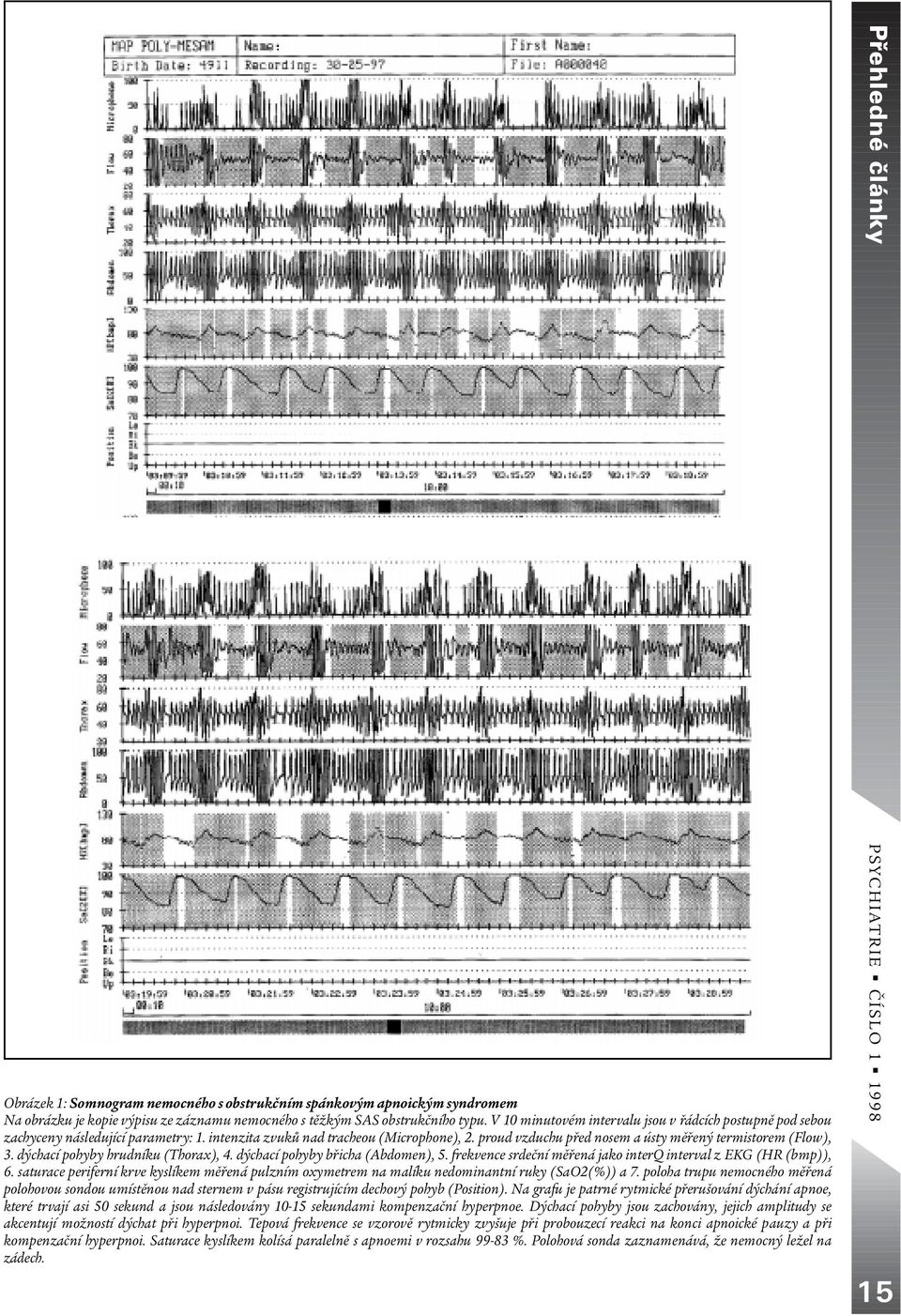 proud vzduchu pøed nosem a ústy mìøený termistorem (Flow), 3. dýchací pohyby hrudníku (Thorax), 4. dýchací pohyby bøicha (Abdomen), 5.