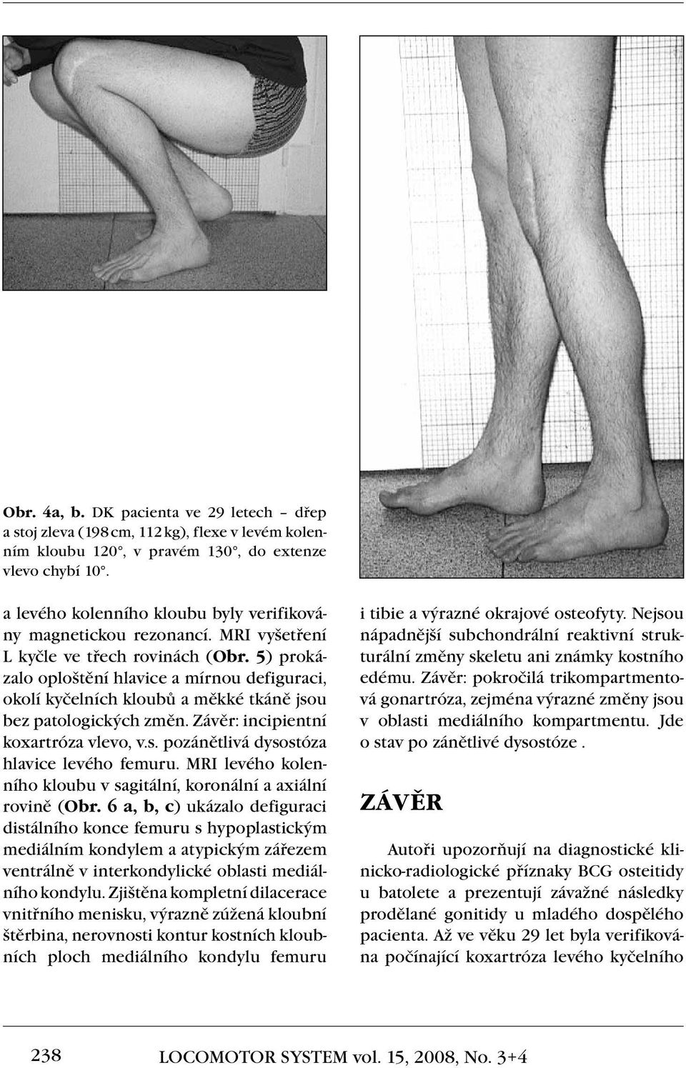 5) prokázalo oploštění hlavice a mírnou defiguraci, okolí kyčelních kloubů a měkké tkáně jsou bez patologických změn. Závěr: incipientní koxartróza vlevo, v.s. pozánětlivá dysostóza hlavice levého femuru.