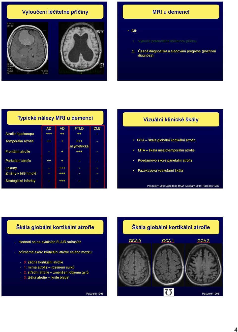 Frontální atrofie - + +++ - Parietální atrofie ++ + - - Lakuny - +++ - - Změny v bílé hmotě - +++ - - - GCA škála globální kortikální atrofie MTA škála meziotemporální atrofie Koedamovo skóre