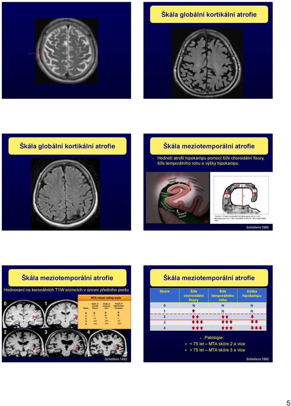 koronálních T1W snímcích v úrovni předního pontu 0 1 2 3 4 Scheltens 1992 Škála meziotemporální atrofie Skóre Šíře chorioidální