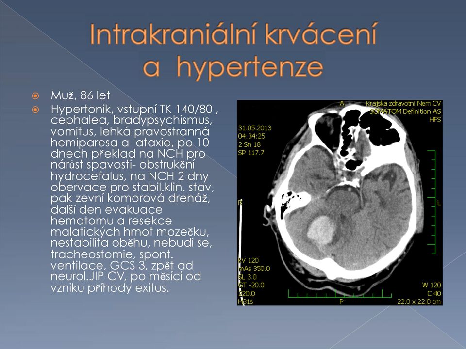 dnech p eklad na NCH pro nár st spavosti- obstruk ní hydrocefalus, na NCH 2 dny obervace pro stabil.klin.