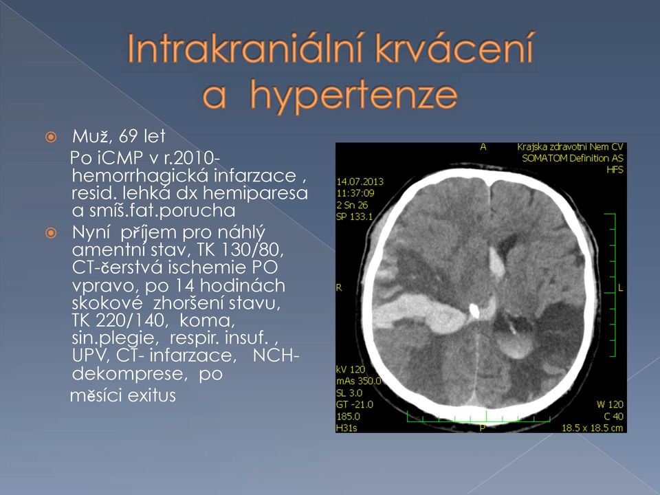 amentní stav, TK 130/80, CT- erstvá ischemie PO vpravo, po 14 hodinách skokové