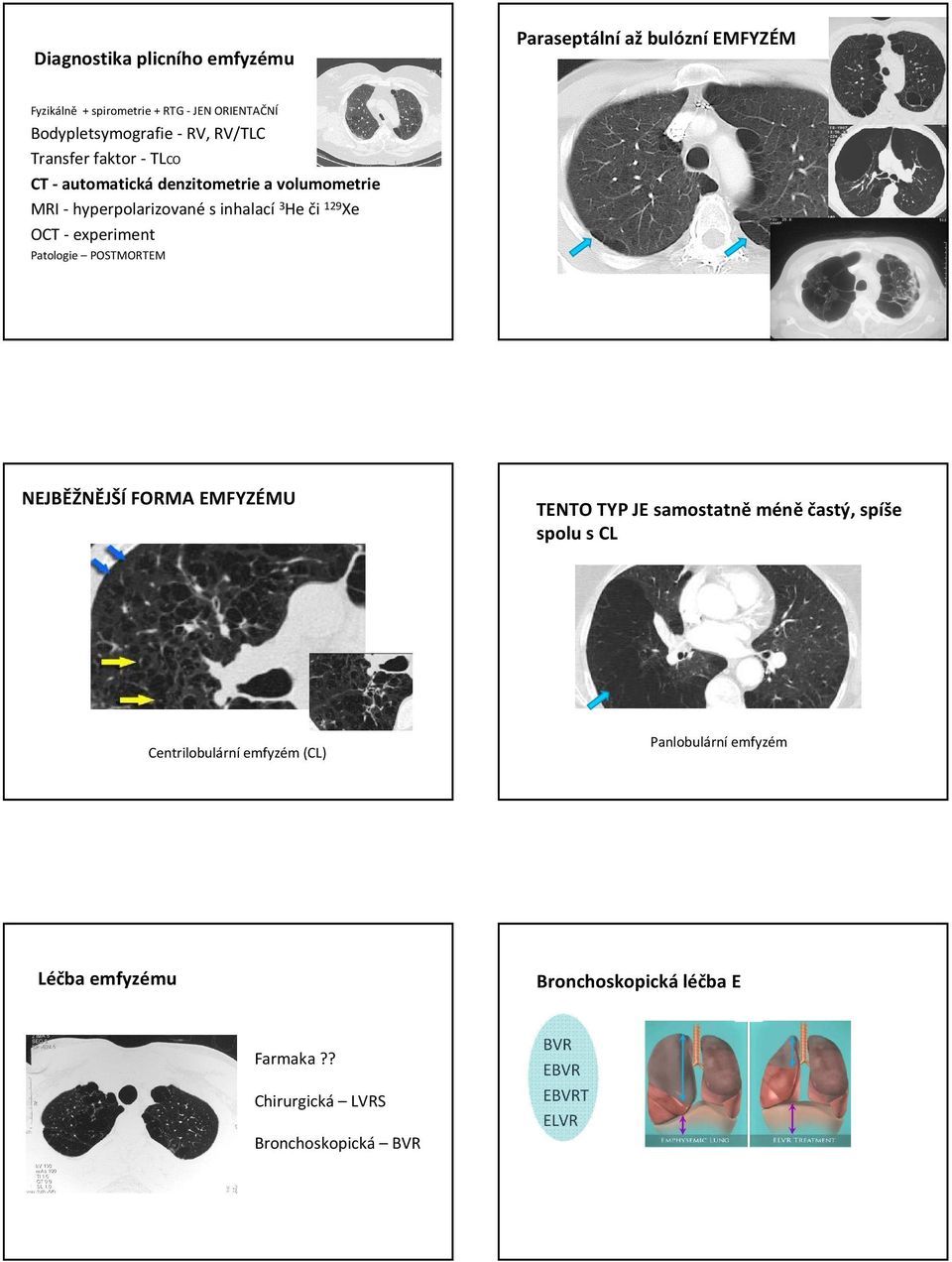 - experiment Patologie POSTMORTEM NEJBĚŽNĚJŠÍFORMA EMFYZÉMU TENTO TYP JE samostatněméněčastý, spíše spolu s CL