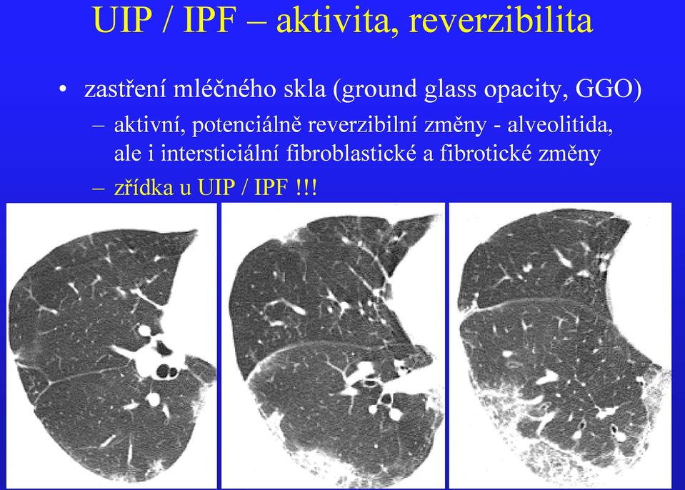 reverzibilní změny - alveolitida, ale i