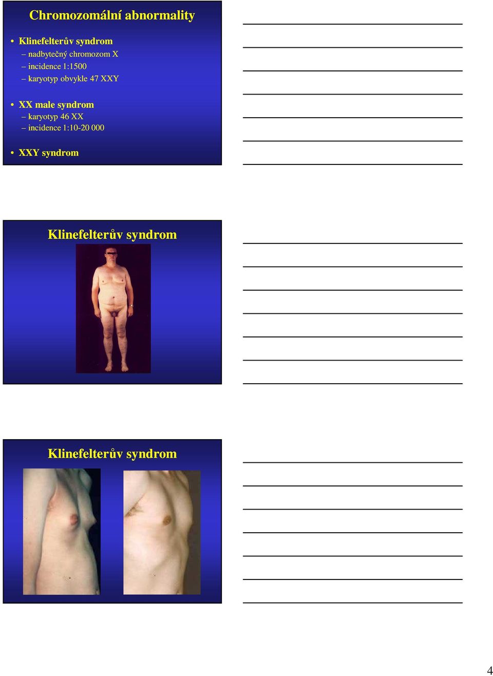 obvykle 47 XXY XX male syndrom karyotyp 46 XX incidence