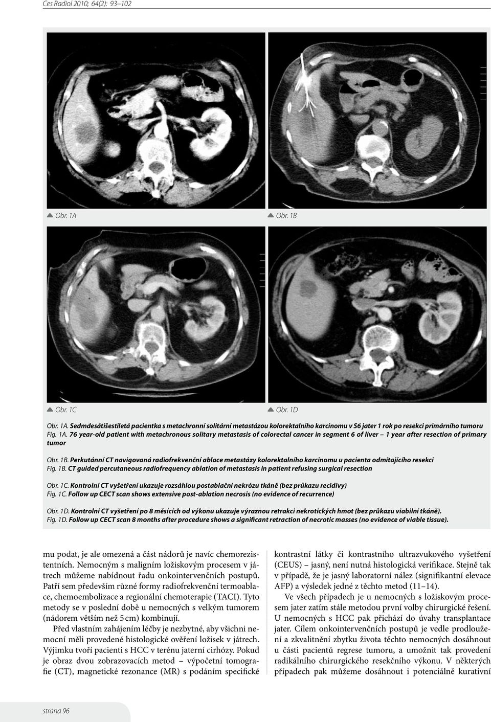 CT guided percutaneous radiofrequency ablation of metastasis in patient refusing surgical resection Obr. 1C.
