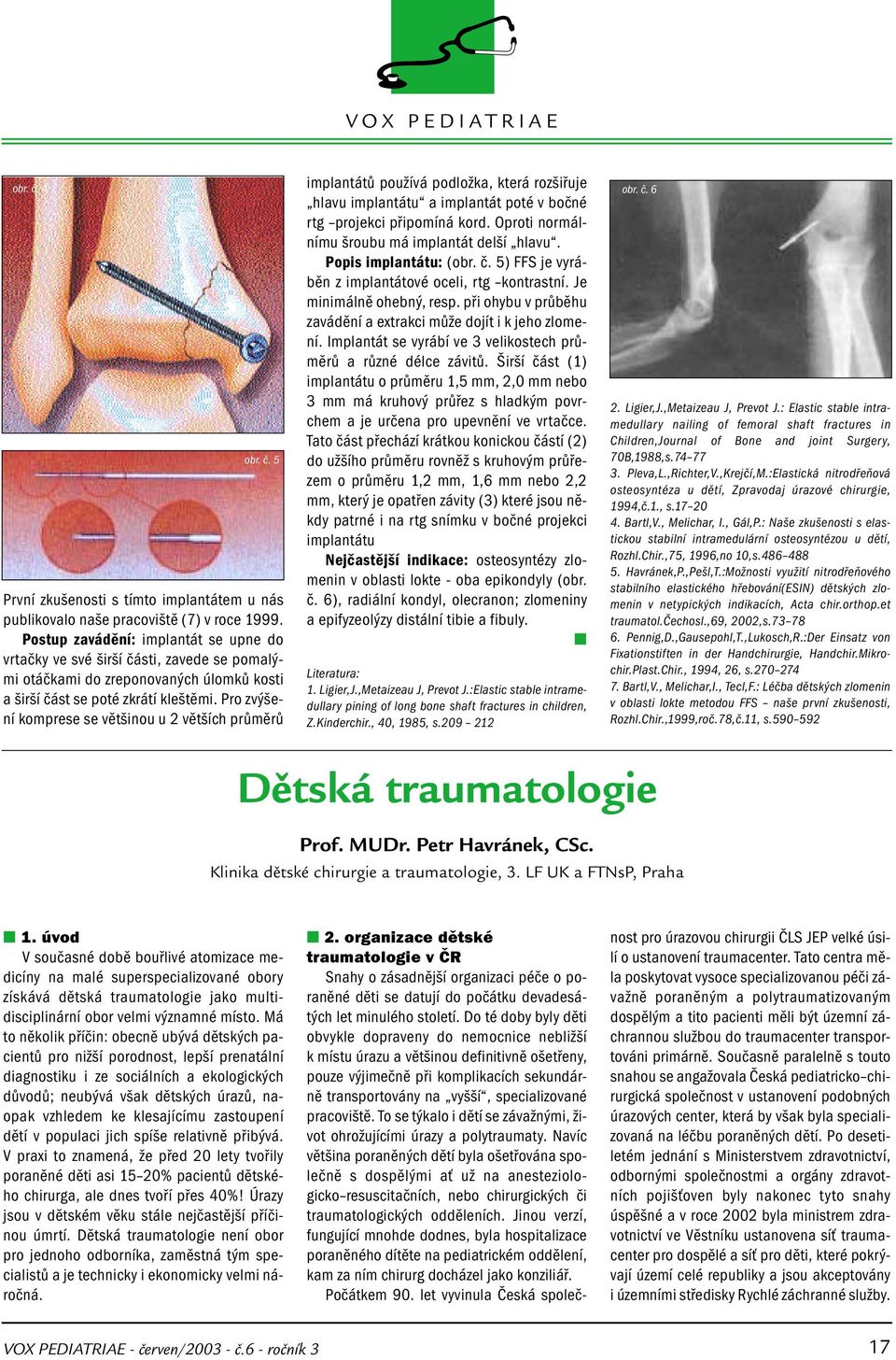 Pro zvýšení komprese se většinou u 2 větších průměrů implantátů používá podložka, která rozšiřuje hlavu implantátu a implantát poté v bočné rtg projekci připomíná kord.