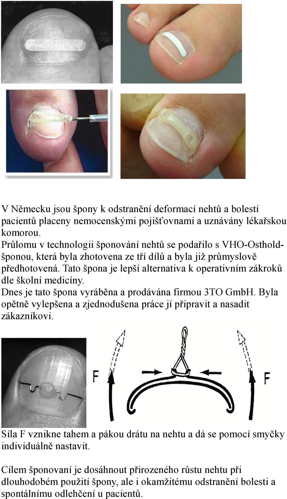 Tato špona je lepší alternativa k operativním zákroků dle školní medicíny. Dnes je tato špona vyráběna a prodávána firmou 3TO GmbH.