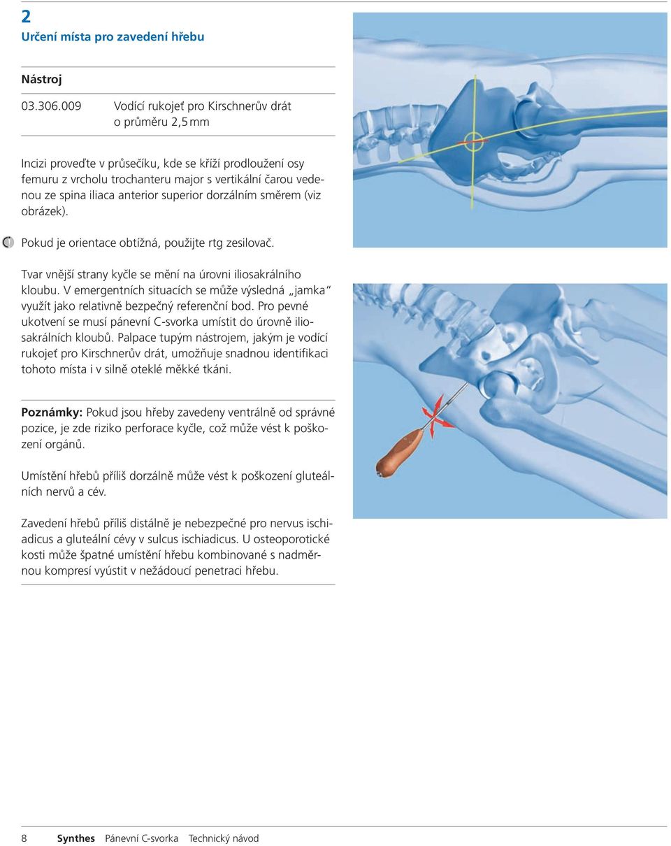 anterior superior dorzálním směrem (viz obrázek). Pokud je orientace obtížná, použijte rtg zesilovač. Tvar vnější strany kyčle se mění na úrovni iliosakrálního kloubu.