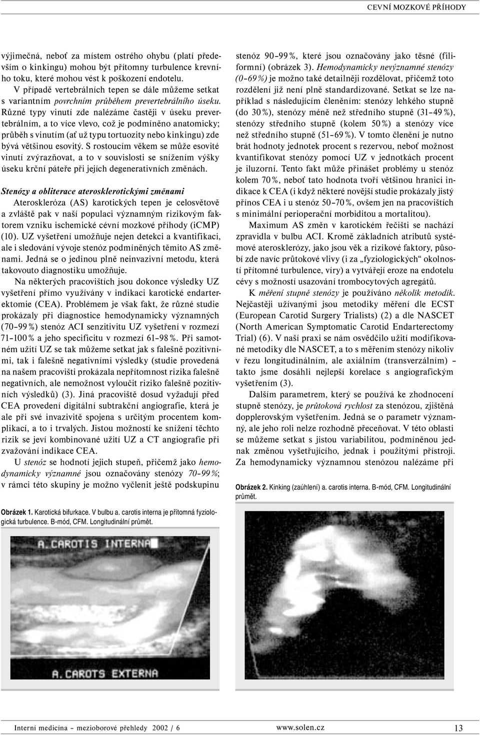 Různé typy vinutí zde nalézáme častěji v úseku prevertebrálním, a to více vlevo, což je podmíněno anatomicky; průběh s vinutím (ať už typu tortuozity nebo kinkingu) zde bývá většinou esovitý.