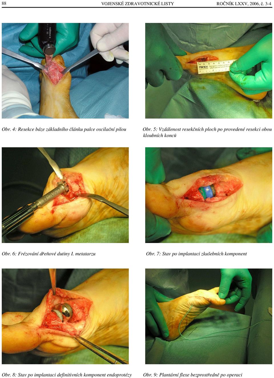 8: Stav po implantaci definitivních komponent endoprotézy ROČNÍK LXXV, 2006, č. 3-4 Obr.