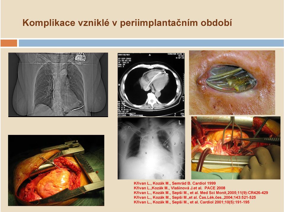 , Sepši M., et al. Med Sci Monit,2005;11(9):CR426-429 Křivan L., Kozák M., Sepši M.,et al.