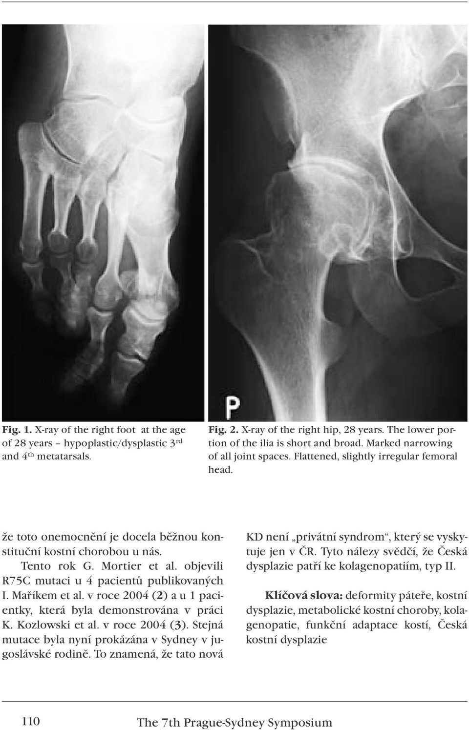 objevili R75C mutaci u 4 pacientů publikovaných I. Maříkem et al. v roce 2004 (2) a u 1 pacientky, která byla demonstrována v práci K. Kozlowski et al. v roce 2004 (3).