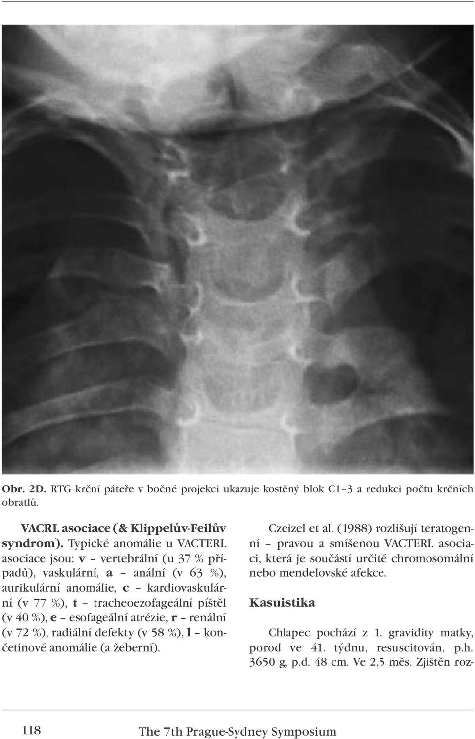 %), e esofageální atrézie, r renální (v 72 %), radiální defekty (v 58 %), l končetinové anomálie (a žeberní). Czeizel et al.