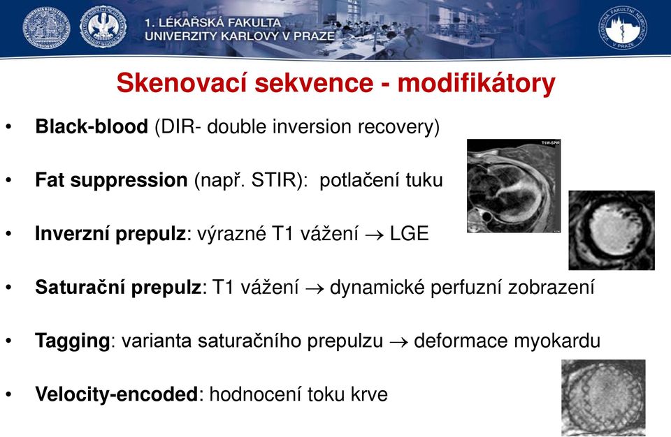 STIR): potlačení tuku Inverzní prepulz: výrazné T1 vážení LGE Saturační