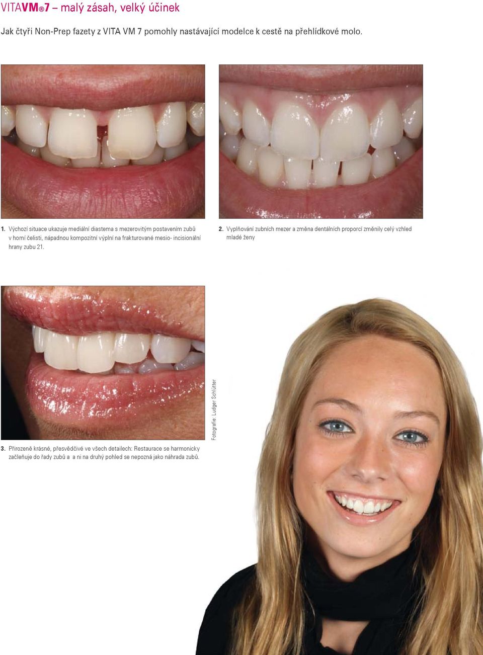 incisionální hrany zubu 21. 2. Vyplňování zubních mezer a změna dentálních proporcí změnily celý vzhled mladé ženy Fotografie: Ludger Schlütter 3.