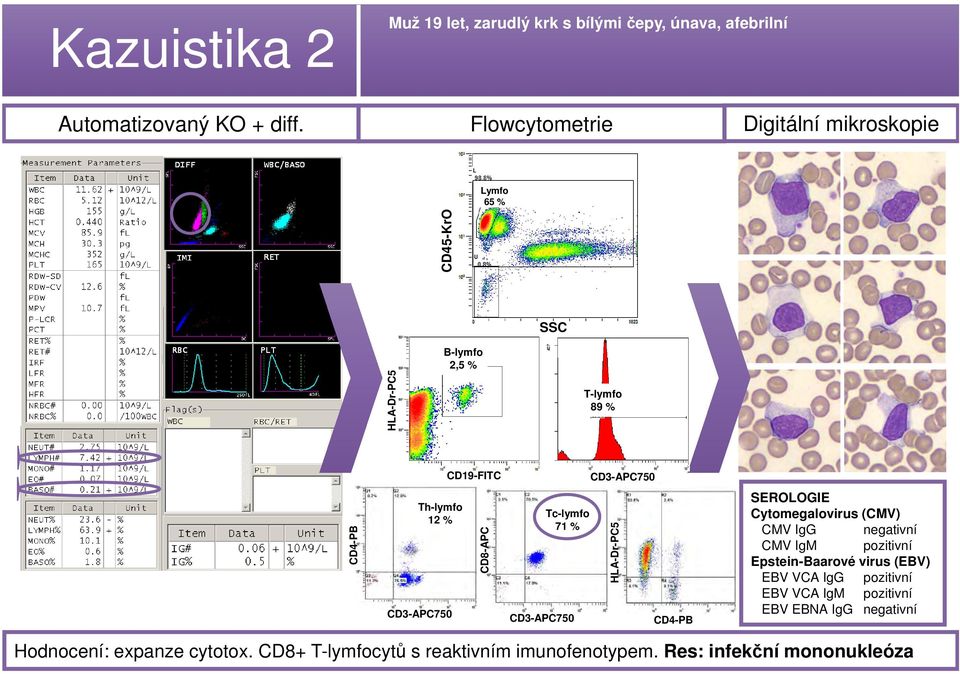 CD8-APC Tc-lymfo 71 % CD3-APC750 HLA-Dr-PC5 CD4-PB SEROLOGIE Cytomegalovirus (CMV) CMV IgG negativní CMV IgM pozitivní Epstein-Baarové