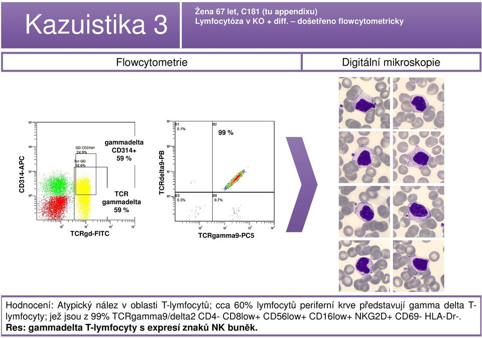 % TCRgd-FITC TCRgamma9-PC5 Hodnocení: Atypický nález v oblasti T-lymfocytů; cca 60% lymfocytů periferní krve