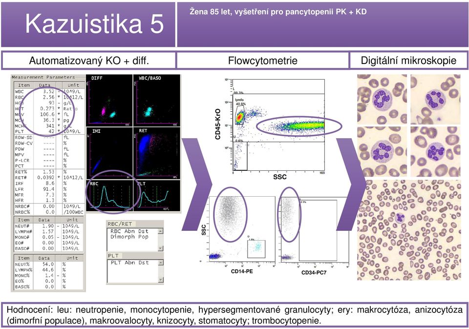 Digitální mikroskopie CD45-KrO CD14-PE CD34-PC7 Hodnocení: leu: neutropenie,