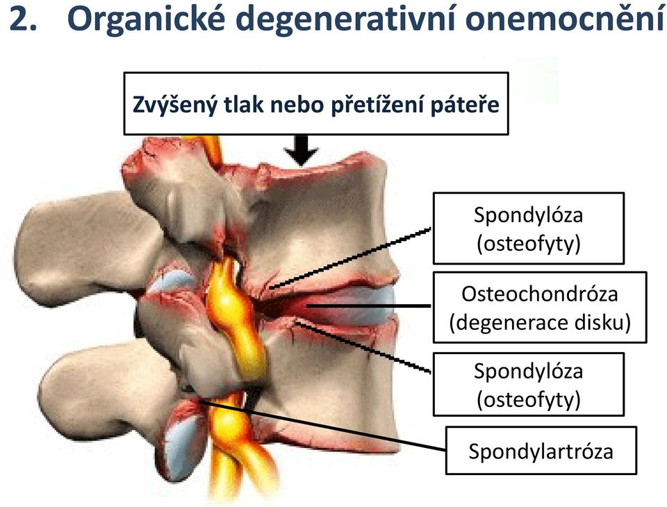 vertebralis C6 C7 Spondylóza (osteofyty) spinální výběžek kořen C6