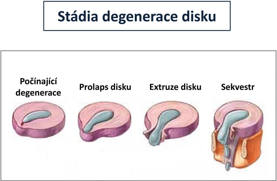 degenerace Prolaps