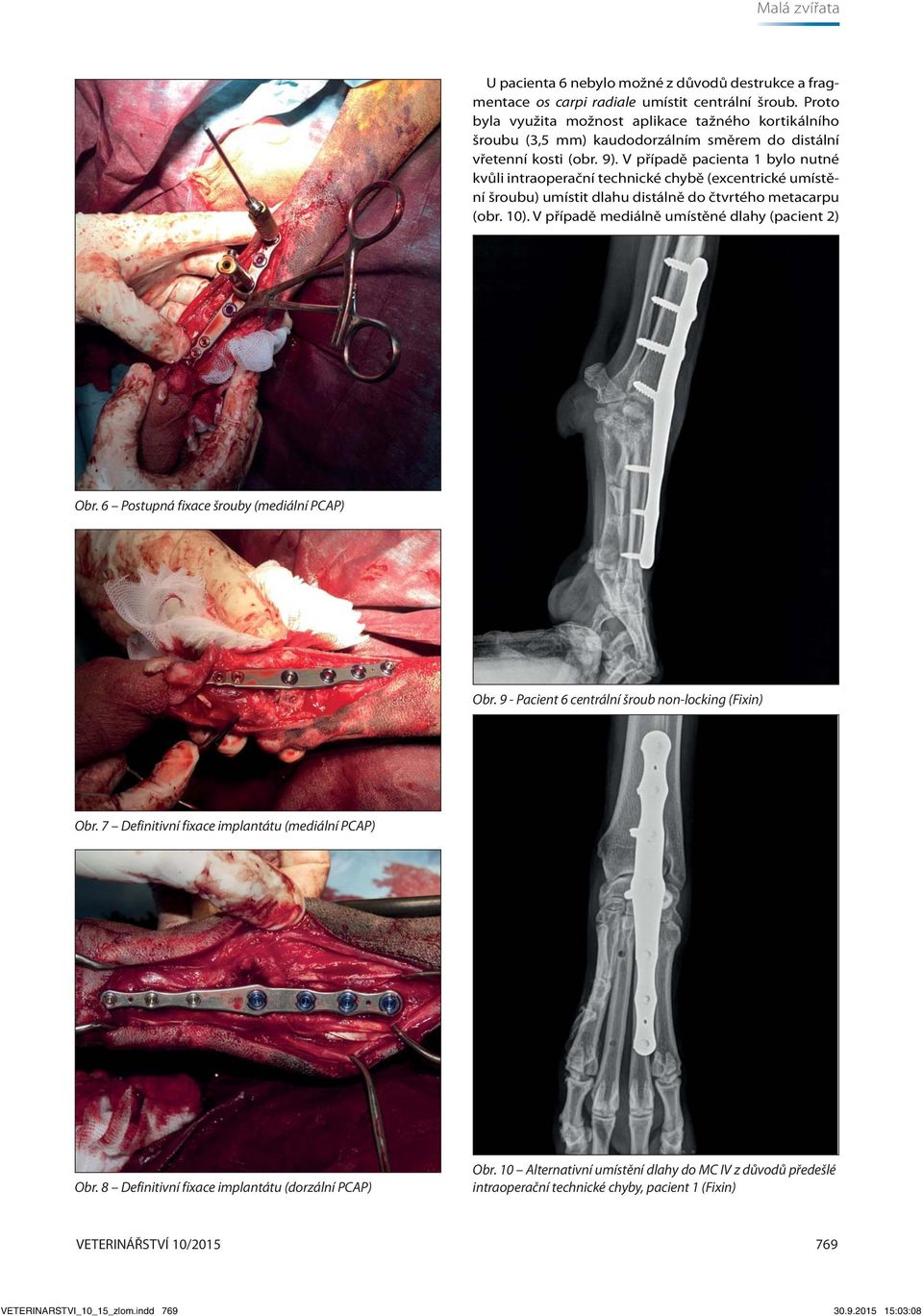 V případě pacienta 1 bylo nutné kvůli intraoperační technické chybě (excentrické umístění šroubu) umístit dlahu distálně do čtvrtého metacarpu (obr. 10).