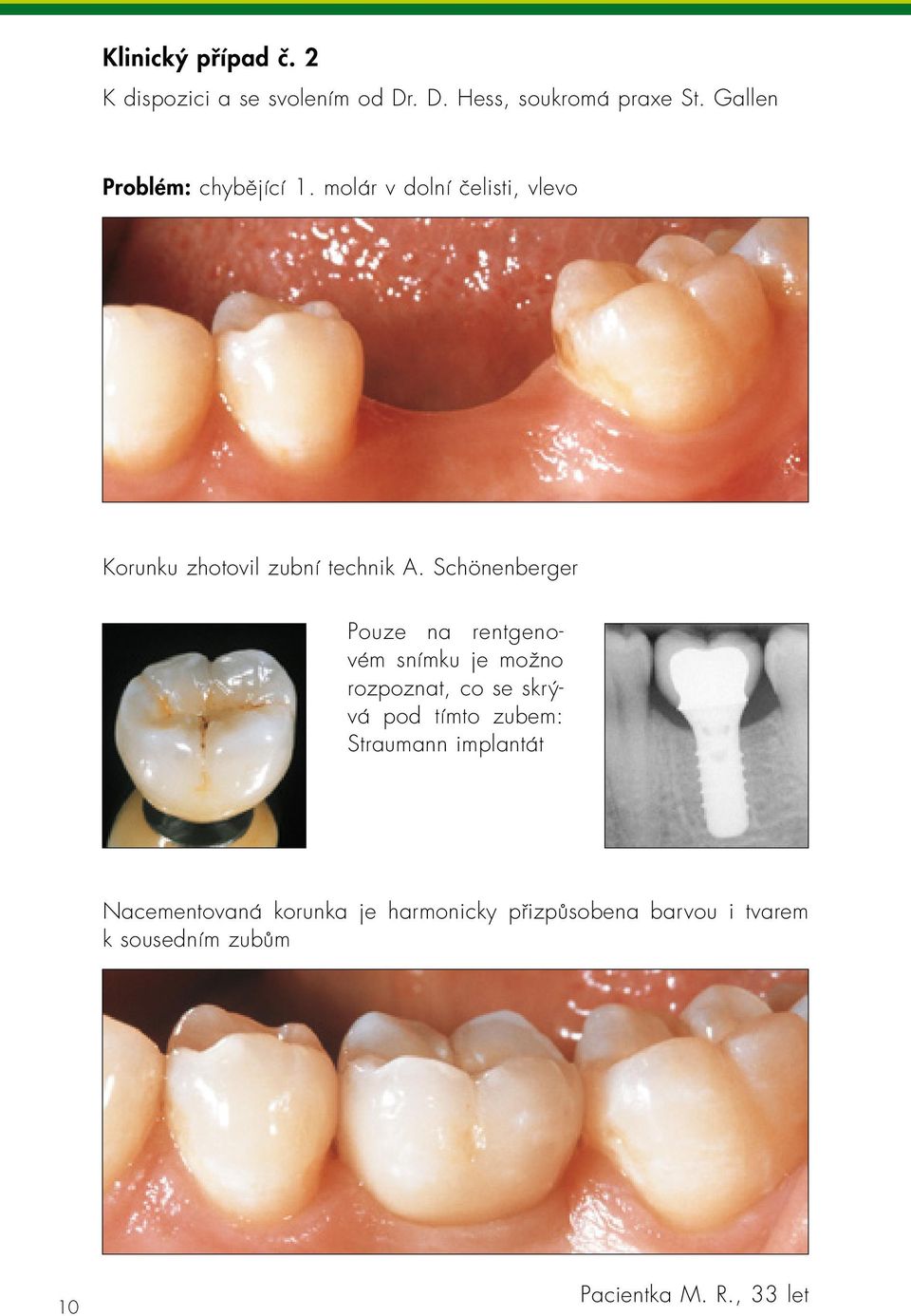 Schönenberger Pouze na rentgenovém snímku je možno rozpoznat, co se skrývá pod tímto zubem: