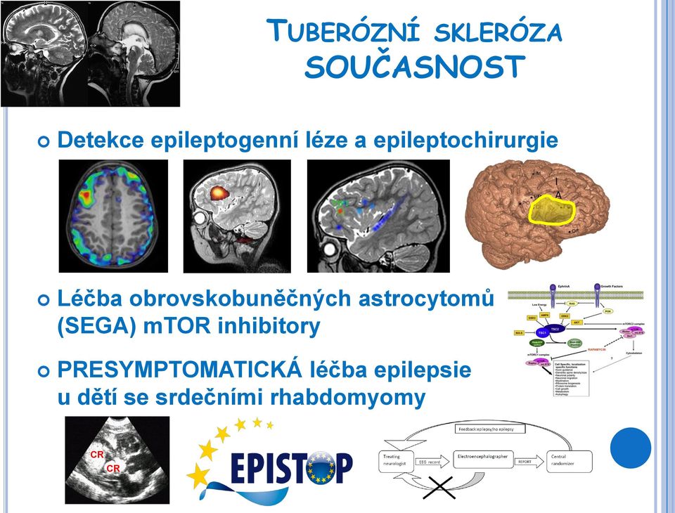 astrocytomů (SEGA) mtor inhibitory PRESYMPTOMATICKÁ