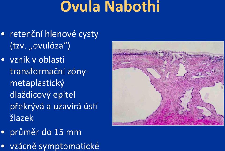 zónymetaplastický dlaždicový epitel překrývá a