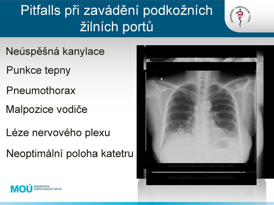 Pneumothorax Malpozice vodiče Malpozice