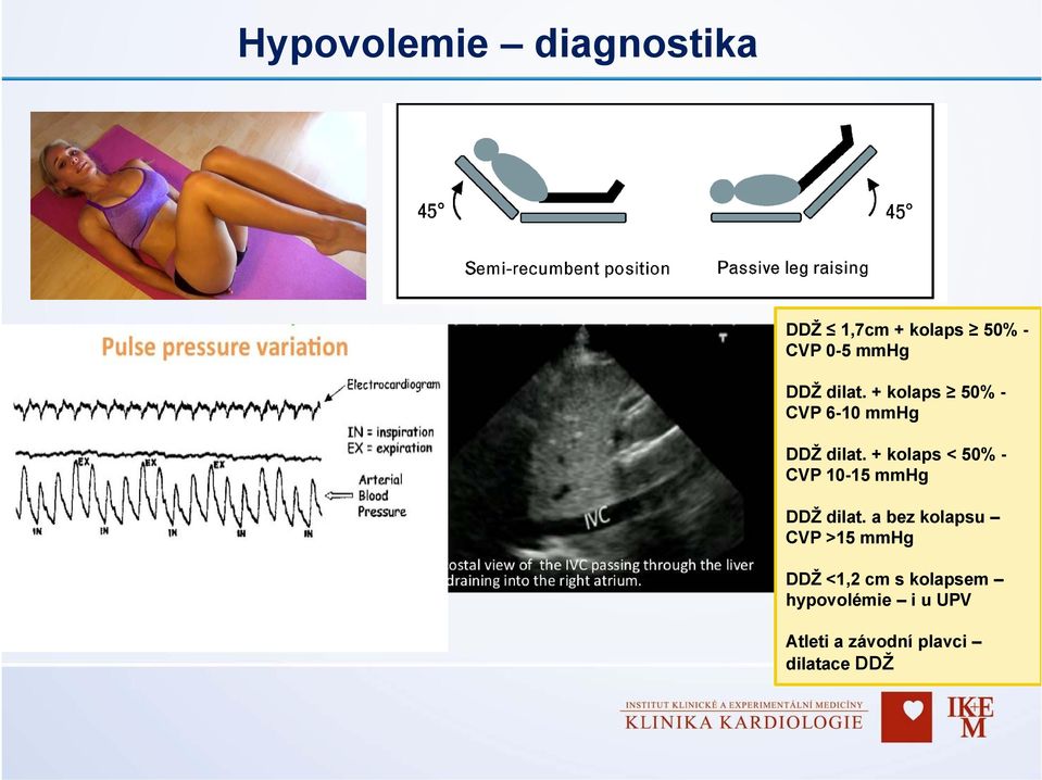 + kolaps < 50% - CVP 10-15 mmhg DDŽ dilat.