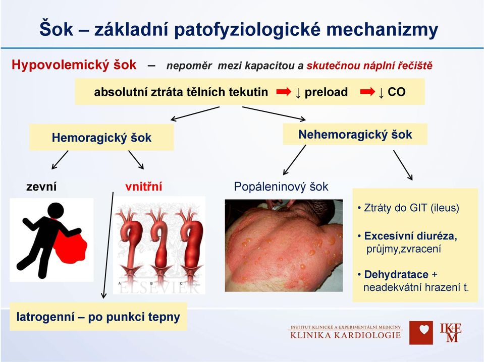 Nehemoragický šok zevní vnitřní Popáleninový šok Ztráty do GIT (ileus) Excesívní