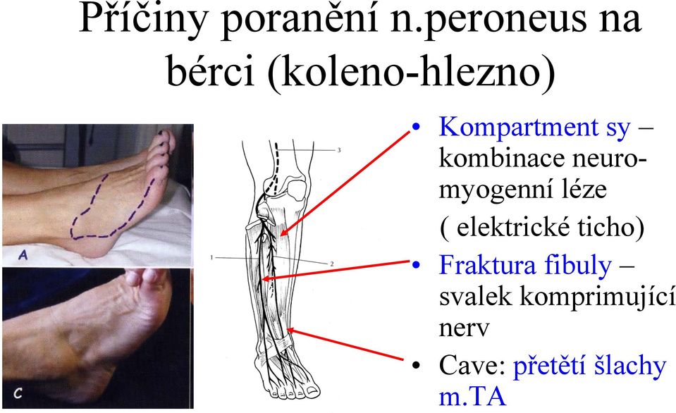 sy kombinace neuromyogenní léze ( elektrické