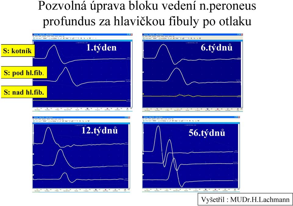 kotník 1.týden 1 týden 6.týdnů 1 měsíc S: pod hl.fib.