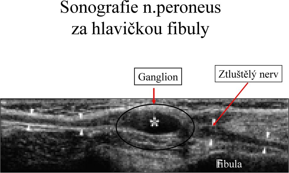 hlavičkou fibuly