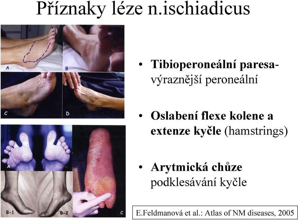 peroneální Oslabení flexe kolene a extenze kyčle