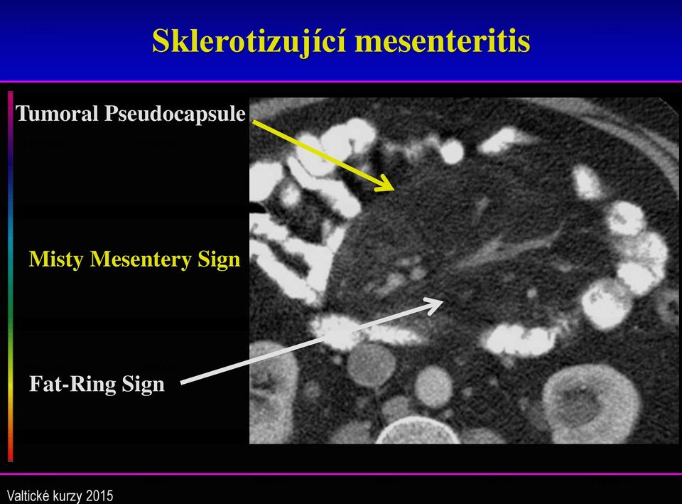 Pseudocapsule Misty