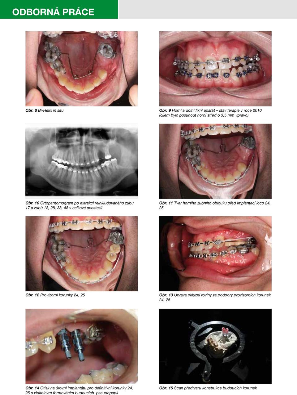 11 Tvar horního zubního oblouku před implantací loco 24, 25 Obr. 12 Provizorní korunky 24, 25 Obr.