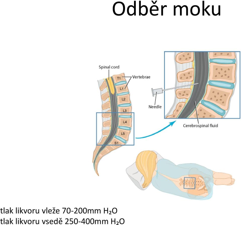 likvoru vsedě