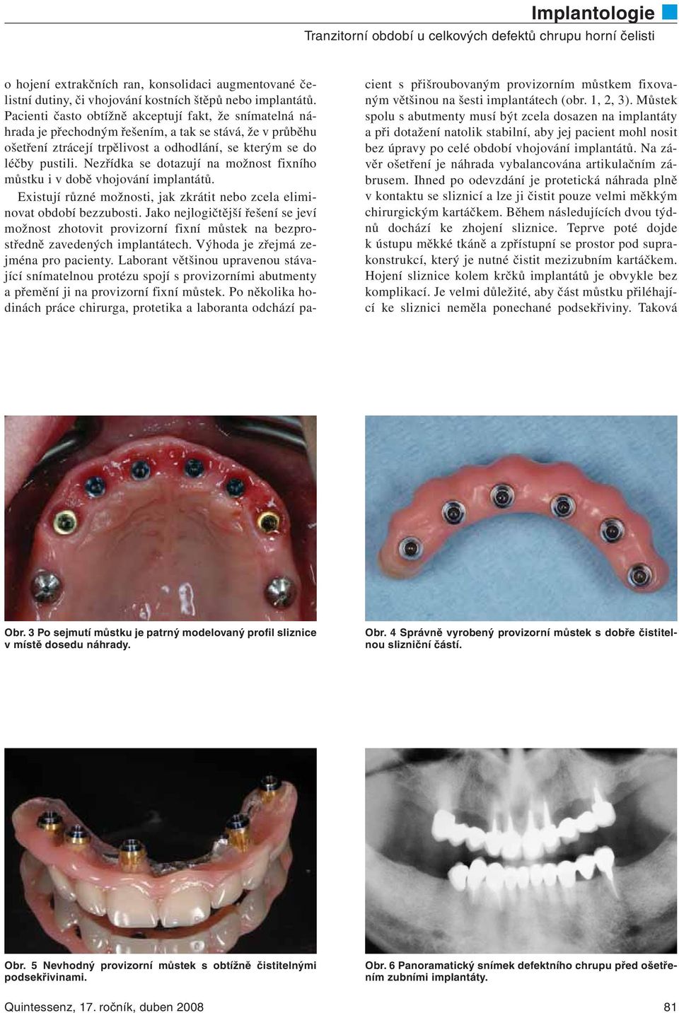 Nezřídka se dotazují na možnost fixního můstku i v době vhojování implantátů. Existují různé možnosti, jak zkrátit nebo zcela eliminovat období bezzubosti.