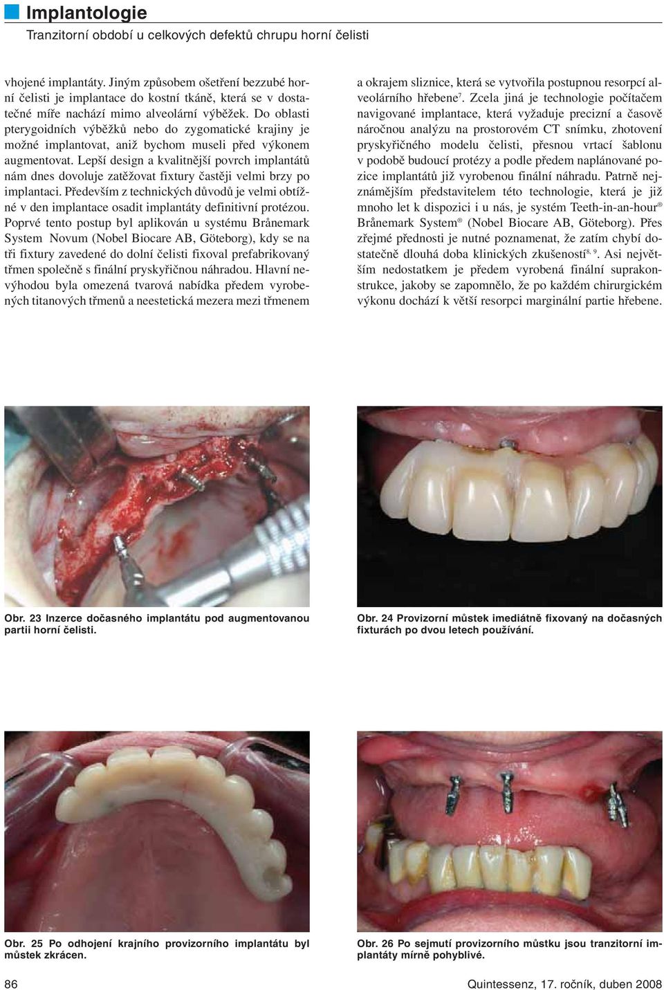 Lepší design a kvalitnější povrch implantátů nám dnes dovoluje zatěžovat fixtury častěji velmi brzy po implantaci.