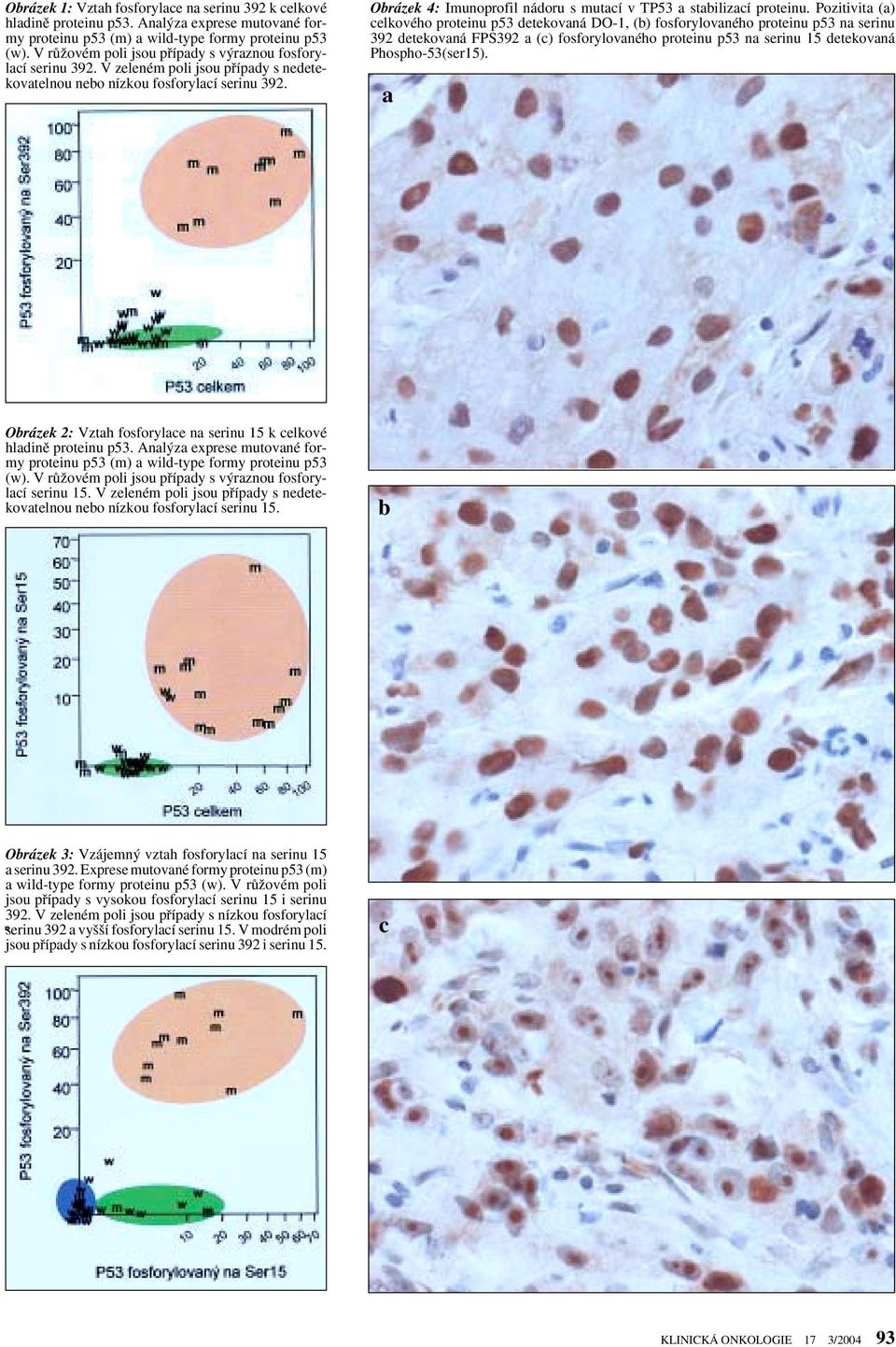 Obrázek 4: Imunoprofil nádoru s mutací v TP53 a stabilizací proteinu.