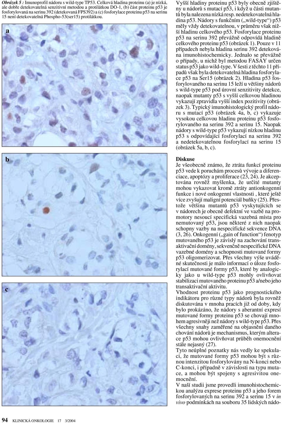 proteinu p53 na serinu 15 není detekovatelná Phospho-53(ser15) protilátkou. a b c Vy í hladiny proteinu p53 byly obecnû zji tûny u nádorû s mutací p53, i kdyï u ãásti mutantû byla nalezena nízká resp.