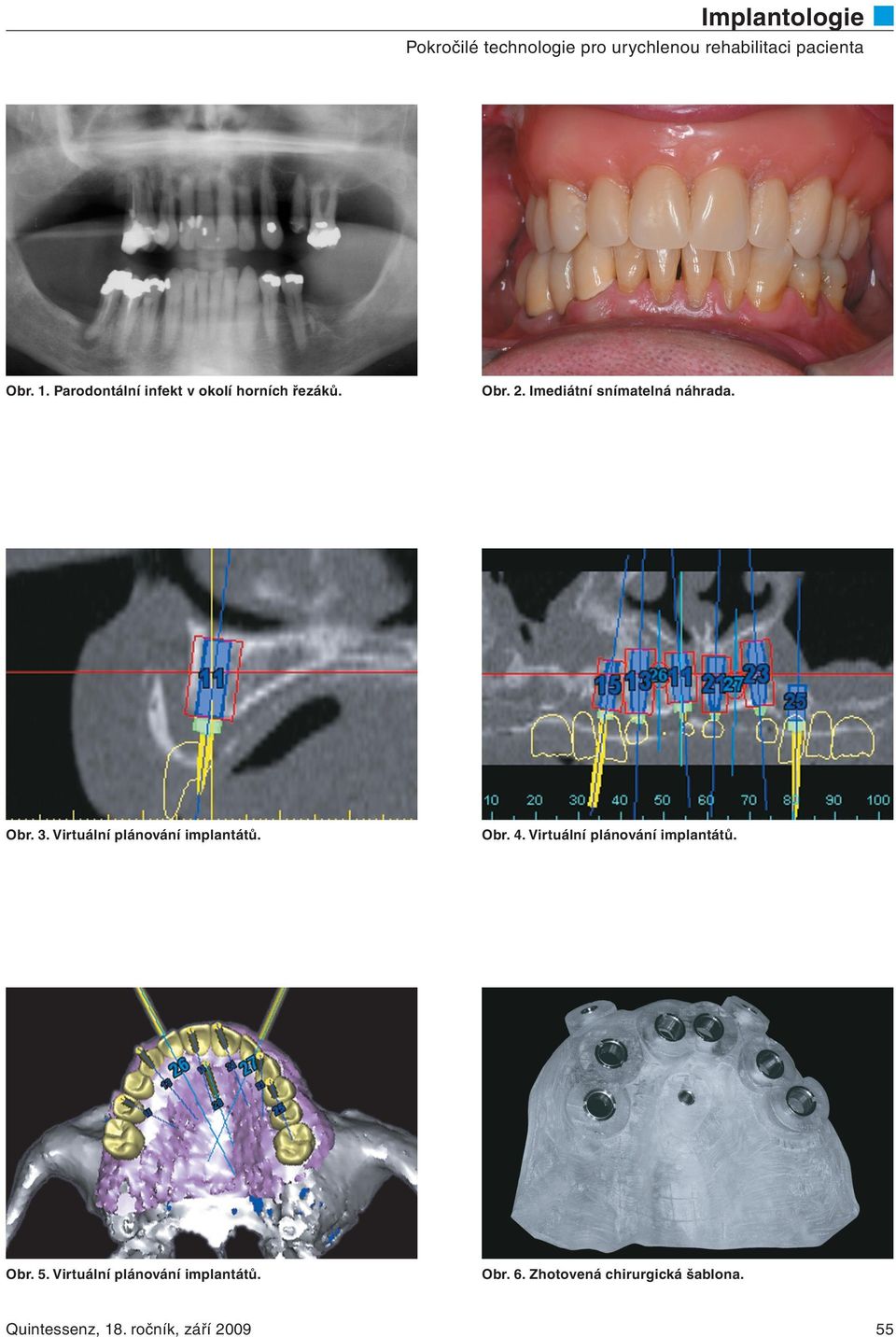 Virtuální plánování implantátů. Obr. 4.